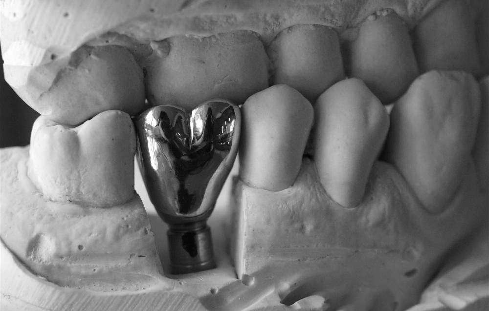 种植上部纯钛金属冠