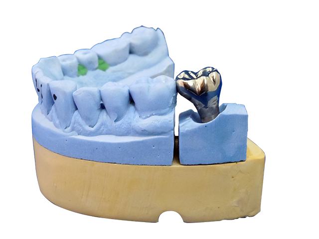 种植上部钴铬合金金属冠